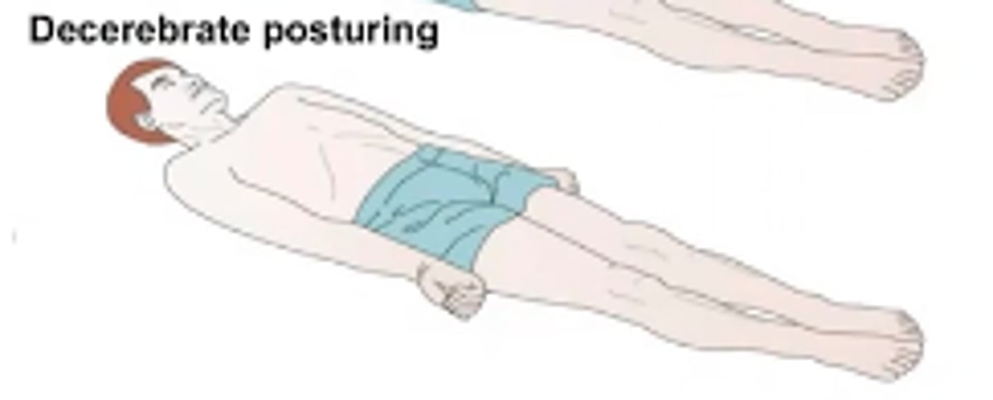 <p>Abnormal extensor response</p><p>Sustained contraction and posturing of the trunk and limbs in full extension</p>