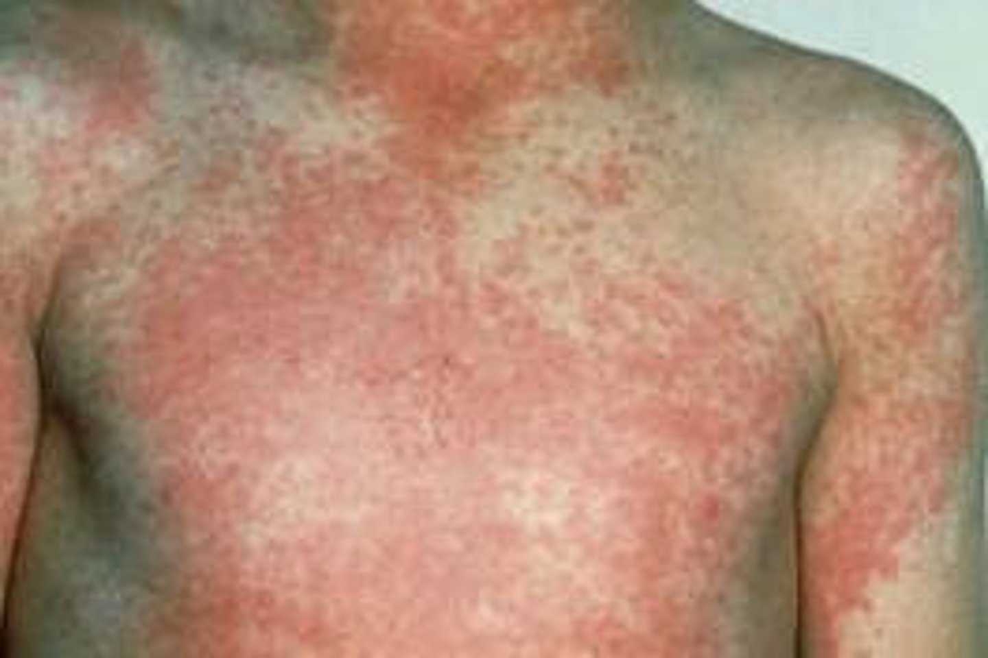 <p>scarlet fever</p>