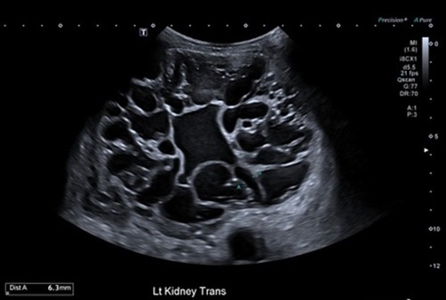 <p>Cystic nephroma does not communicate with the renal ___ </p>