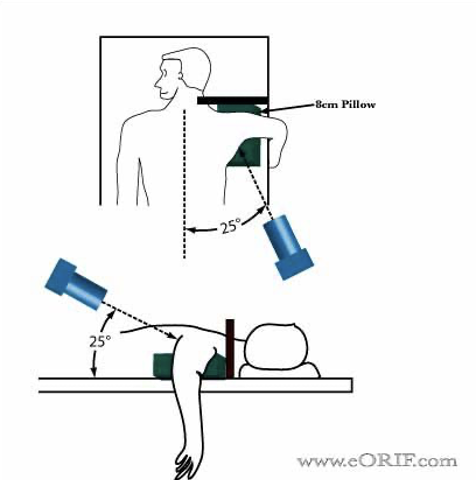 <ul><li><p>Patient is prone</p></li><li><p>Affected shoulder placed on a sponge, elevating it 8cm </p></li><li><p>Arm is abducted 90deg with forearm hanging over table</p></li><li><p>IR is placed at superior part of the affected shoulder </p></li></ul><p>Tube rotation: 25 deg to mid-sagittal plane and 25 deg caudal angulation</p><p></p>
