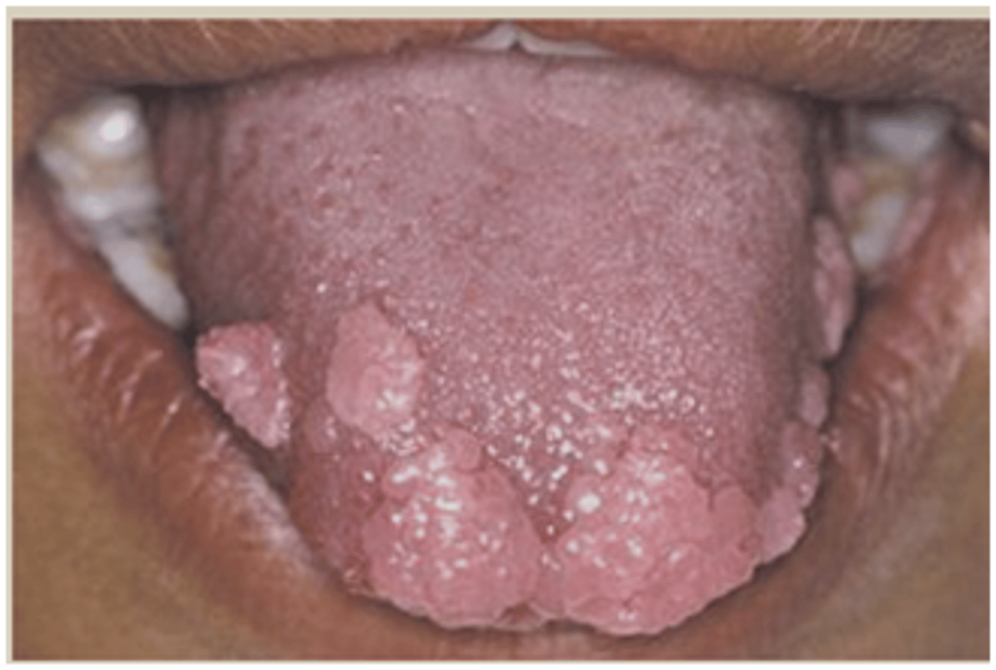<p>Multifocal Epithelial Hyperplasia</p>