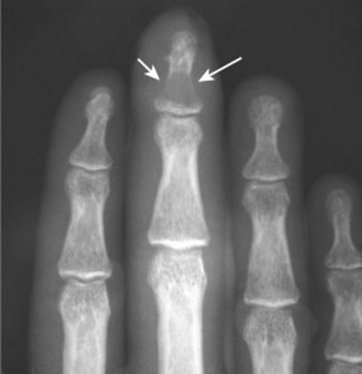 <p>focal destruction of bone by blood-borne infectious agent (s. aureus)</p><p>xray- initial study, can take up to 10 days to display first findings</p><p>MRI- most widely used</p><p>radionuclide bone scan- higher sensitivity than MRI of approx 95%</p><p>- focal cortical bone destruction</p><p>- periosteal new bone formation</p><p>- soft tissue swelling and focal osteoporosis</p>