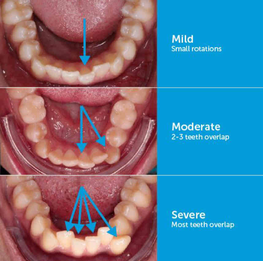 <ul><li><p>tooth size arch length deficiency </p></li><li><p>due to insufficient jaw size to accommodate teeth size (ie. change in distance between the lower canines)</p></li><li><p>happens in adult </p></li></ul>