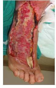 <p>blistering, skin discoloration due to necrosis, destruction of skin, subcutaneous and peri muscular fat with necrotic liquefaction of fatty tissue. 20-4-% mortality</p><p>once culture is confirmed, treat with high dose IV benzylpenicillin (7-10 days). surgical debridement</p>