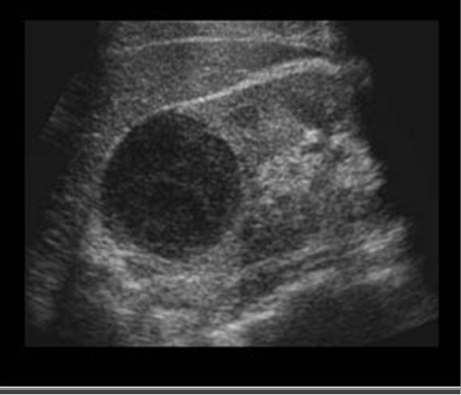 <p>abscesses, fatty tissue</p><p>Darker = less echoes</p>