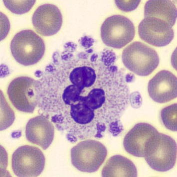 <ul><li><p>a phenomenon when patient’s blood reacts with EDTA</p></li><li><p>causes platelets to ring around neutrophils</p></li><li><p>produces a <em>falsely low platelet count</em></p></li><li><p>can only be corrected by collecting specimens in sodium citrate tubes</p></li></ul><p></p>