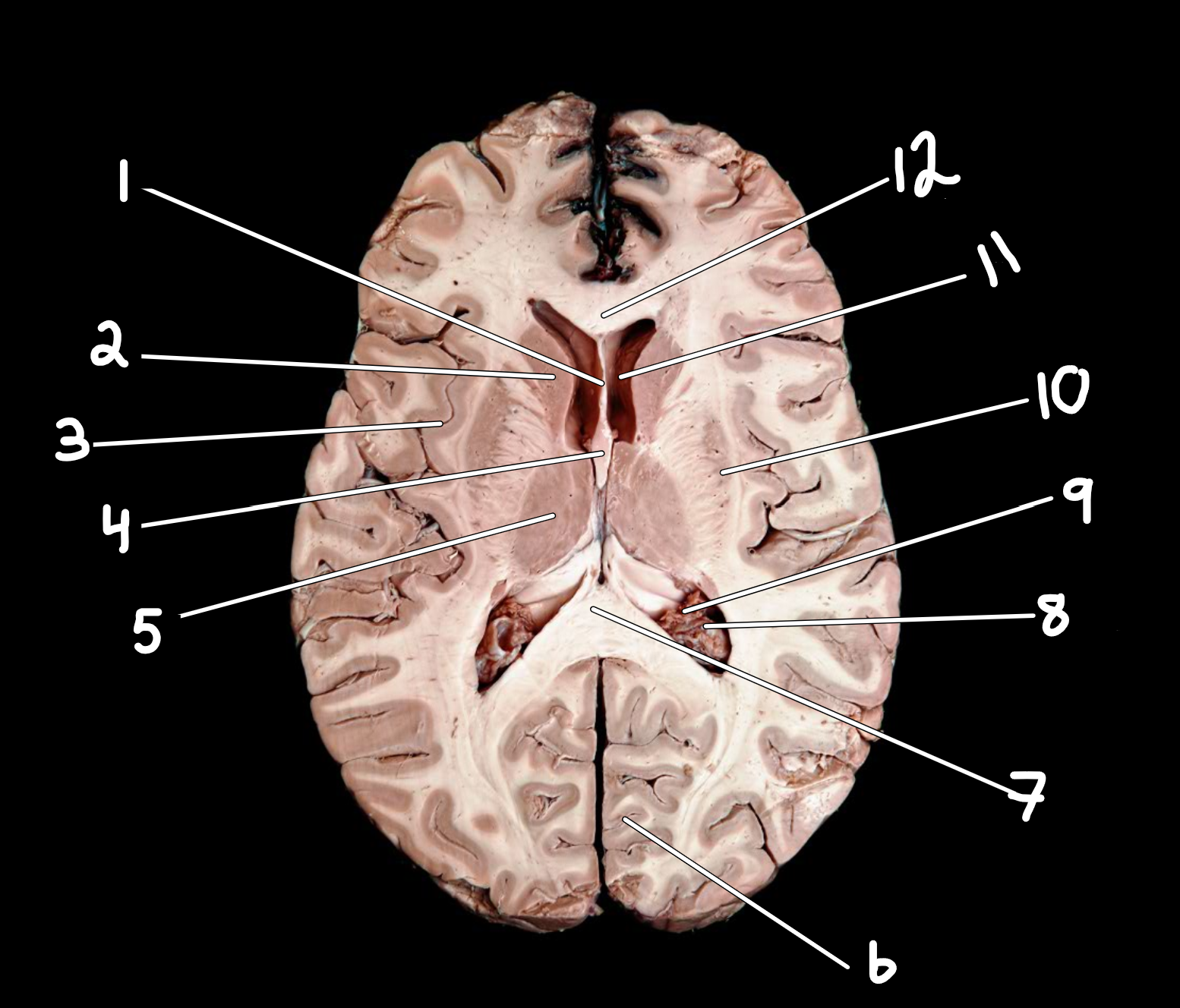 <p>Brain: transverse section </p>