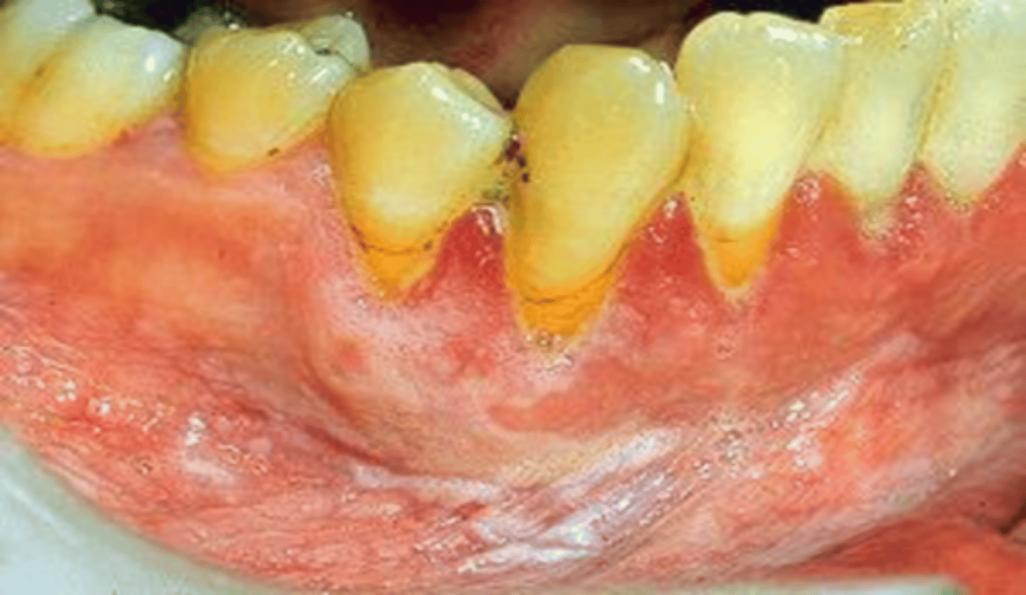 <p>Form of hyperkeratosis; Chronic rubbing or friction against an oral mucosal surface; resembles a callus on skin; appears opaque white</p>