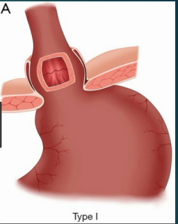 <p><strong>Type 1: Sliding Hernia (MC)</strong></p><p>-__ junction slides _____ diaphragm with some of the stomach</p><p>-Could be due to a congenitally _____ esophagus, fibrosis or excessive _____ nerve stimulation, or weakening of the diaphragmatic ________ at the GEJ contributes </p><p>-______ position causes hernia to slide up and standing causes it to slide ______</p><p>-Exacerbated by increased intraabdominal ___________ secondary to coughing, bending, tight clothing, obesity, etc. </p><p>-Associated with ______ (diminishes resting pressure of ___)</p>