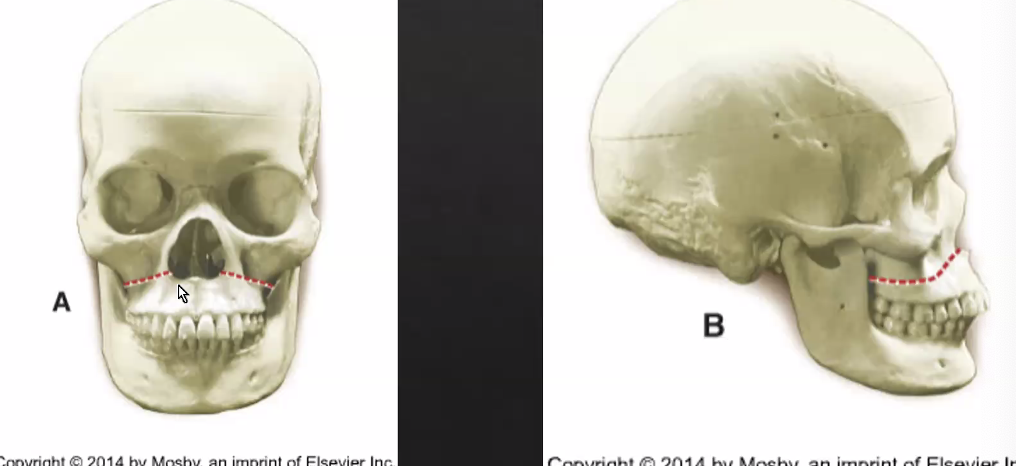 <p>horizontal fracture of maxilla</p><ul><li><p>least amount of force to cause fracture</p></li></ul><p></p>