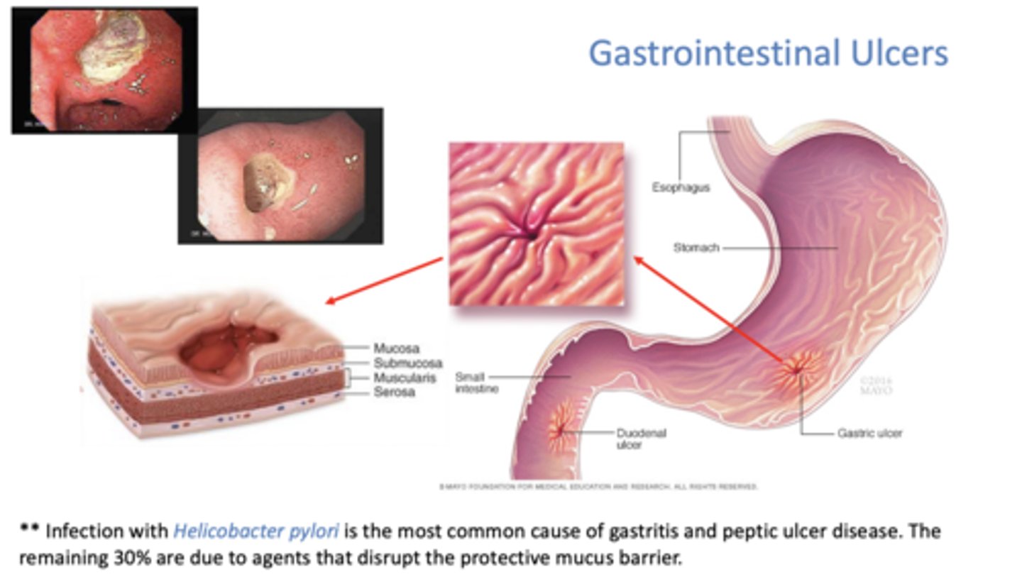 <p>infection with H. Pylori</p>