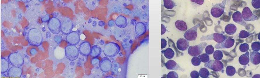 <p>Lymph node cytology</p><p>Enlarged lymph nodes - disease</p><p>Lymphoma</p><p>Cyto Dx?</p>