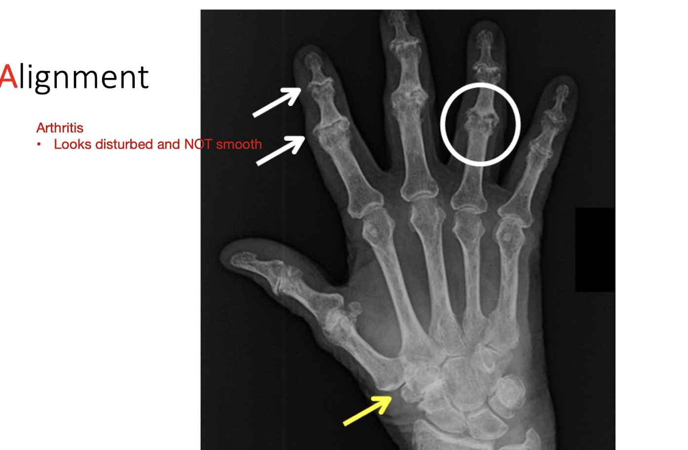 <ul><li><p>Alignment of bones relative to adjacent bones</p></li><li><p>Fx</p><ul><li><p>How this may disrupt jt articulations</p></li></ul></li><li><p>Dislocation </p><ul><li><p>Do joint articulations look normal </p></li></ul></li><li><p>Subluxation</p><ul><li><p>Partial dislocations </p></li><li><p>Signs of recent dislocations </p></li></ul></li></ul><p></p>