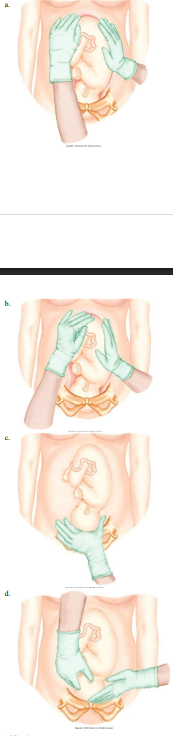 <p>The nurse is performing Leopold’s maneuvers on her patient. Which figure depicts the Leopold’s maneuver that determines whether the fetal presenting part is engaged in the maternal pelvis? Refer to Figures A to D. </p>