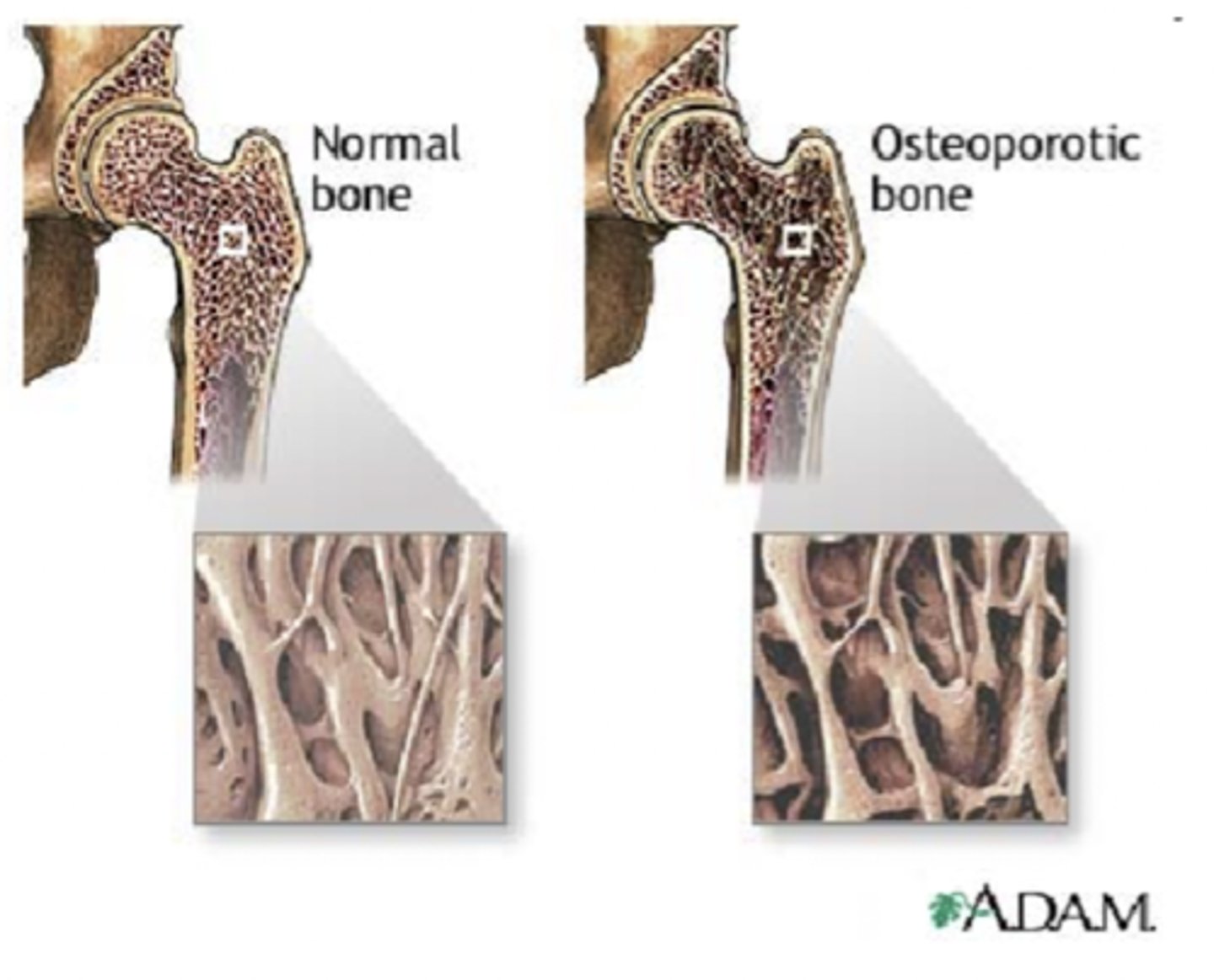 <p>A condition in which the body's bones become weak and break easily.</p>