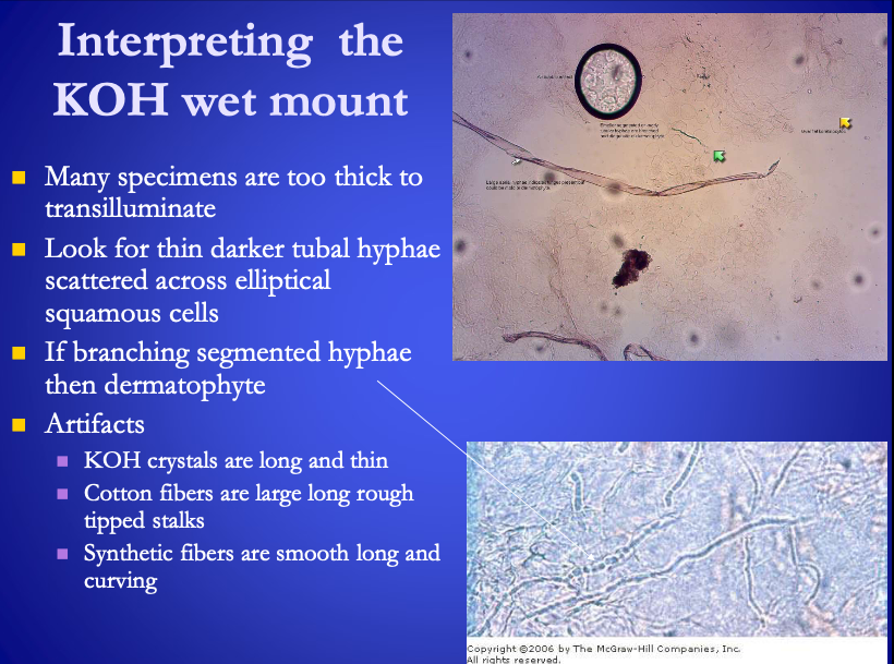 <p>Interpreting KOH</p><ul><li><p>Mold appear as <span><strong>[...]</strong></span></p></li><li><p>Candida albicans is characterized by <span>pseduohyphae</span><br></p><ul><li><p>Terminally segmented, shorter rectangular buds&nbsp;</p></li></ul></li></ul><p></p>