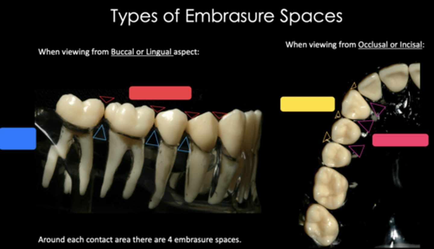 <p>Identify the embrasure space in red</p>