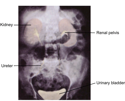 <p>is a procedure used to visualize the entire urinary tract. A parenteral contrast medium cleared by glomerular filtration is used to detect ureteral obstruction, masses, tumors, and cysts.</p>