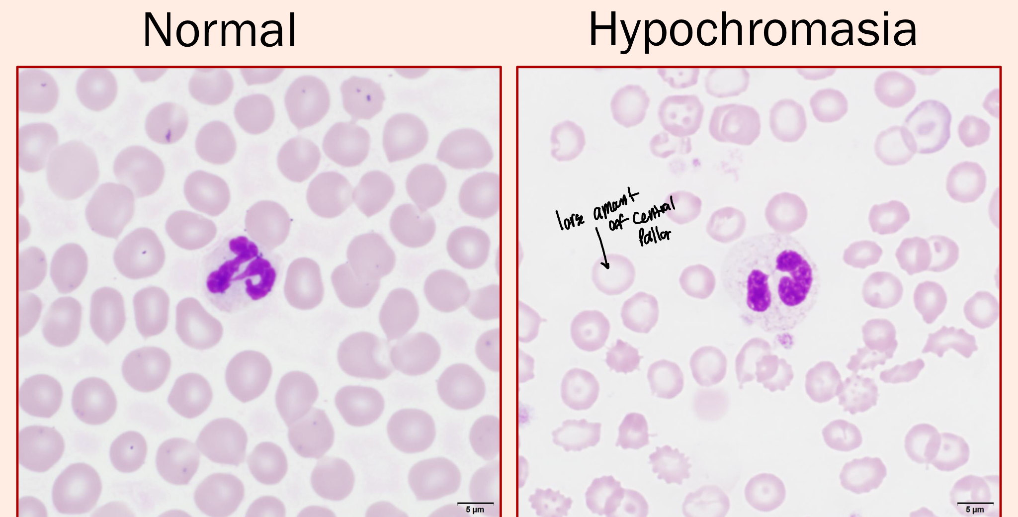 <ul><li><p>RBCs with increased central pallor (whiter/clearer in the middle)</p></li><li><p>Hypochromic Erythrocytes have a decreased Hgb</p></li><li><p>They indicate a decreased MCHC</p></li></ul><p></p>