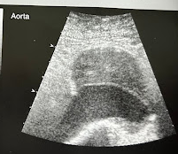 <p>A 70 year old man collapsed at a shopping mall and was transferred to the ED at the nearest hospital. The pt is hypotensive, is in shock, and has pulsatile abd. mass. A portable sonogram is requested immediately and reveals a dilated Ao that measures 8.5cm in AP diameter. What diagnosis do the clinical and sonographic findings suggest? How do the clinical findings contribute to the diagnosis?</p>