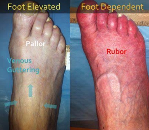 <ul><li><p>cause: Atherosclerosis = narrowed arteries ↓ blood flow to extremities</p></li><li><p>s/s: <span style="color: blue"><em>Cool, pale legs</em>, <em>hair loss</em>,</span><span style="color: purple"> <strong><em><u>intermittent claudication</u></em></strong></span><strong><u>,</u></strong> <span style="color: green"><strong><em>ulcers on toes</em>,</strong></span> <strong>pain ↑ w/ elevation</strong></p></li><li><p><strong>KEY: </strong>↓ pulses, dry wounds, cap refill slow, ABI < 0.9</p></li><li><p><span style="color: red"><strong>action: dangle legs</strong></span></p></li></ul><p>dependent rubor when elevated white, when lowered turns red, </p>