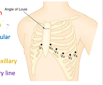<ul><li><p>V1: 4th intercostal @ R sternum</p></li><li><p>V2: 4th intercostal @ L sternum</p></li><li><p>V4: 5th intercostal @ Midclavicular (BEFORE V3)</p></li><li><p>V3:&nbsp;directly between V2 and V4</p></li><li><p>V5: 5th intercostal @ anterior axillary</p></li><li><p>V6: 5th intercostal @ midaxillary line</p></li></ul><p></p>