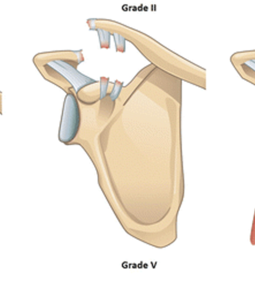 <p>According to the Rockwood Classification System, a grade V ACJ separation entails: __________</p>
