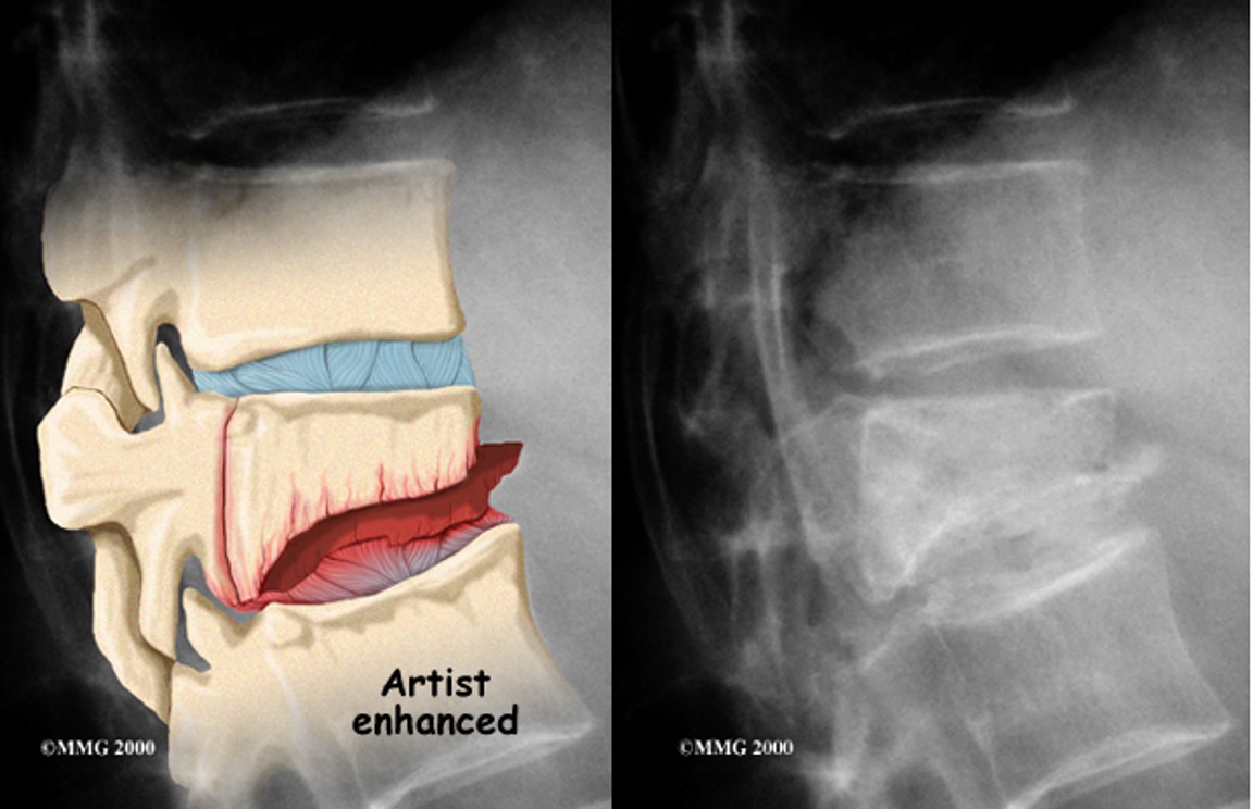 <p>what type of fracture is this?</p>