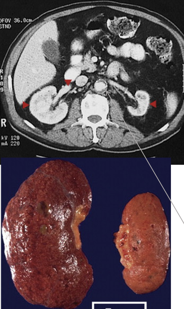 <p>What is indicated by these images?</p><p>What is wrong with the right kidney?</p><p>What can happen from the issue with the left kidney?</p>