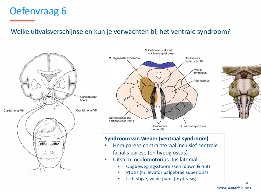 <p>Ventral syndroom → a. basilaris</p><p>Andere zenuwen liggen dorsaal dus worden niet aangedaan.</p><p><strong>Ipsilateraal?</strong></p><p>N. Facialis en Hypoglossus en N. oculomotorius worden aan gedaan. omdat deze vezels ventraal liggen in het mesencephalon zijn.</p>