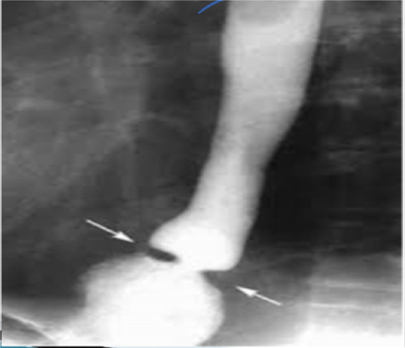 <p>Define Condition:</p><p>2 to 4 mm mucosal stricture (no muscular layer involved) that causes a ring-like narrowing of the distal esophagus by the squamocolumnar junction</p><p>-Hx: GERD</p><p>-Sx: Sporadic &amp; Intermittent Sx (DYSPHAGIA)</p><p>-Tx: Dilation Therapy</p>