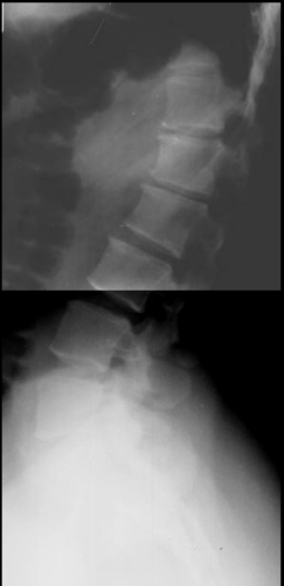<p>ID lumbar lordosis</p>