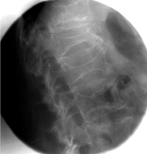 <p><span><span>–Type, size, and composition will influence radiographic technique</span></span></p><p><span><span>–Obtaining good patient history and previous exams will help assessment</span></span></p><p><span><span>–Destructive process causing tissue to be more radiolucent. Ex: osteoporosis</span></span></p><p><span><span>–Constructive in increase mass density and composition. Ex: osteopetrosis </span></span></p>