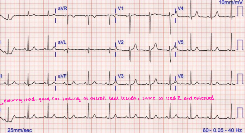 <p>How many seconds does each small box represent on the EKG?</p>