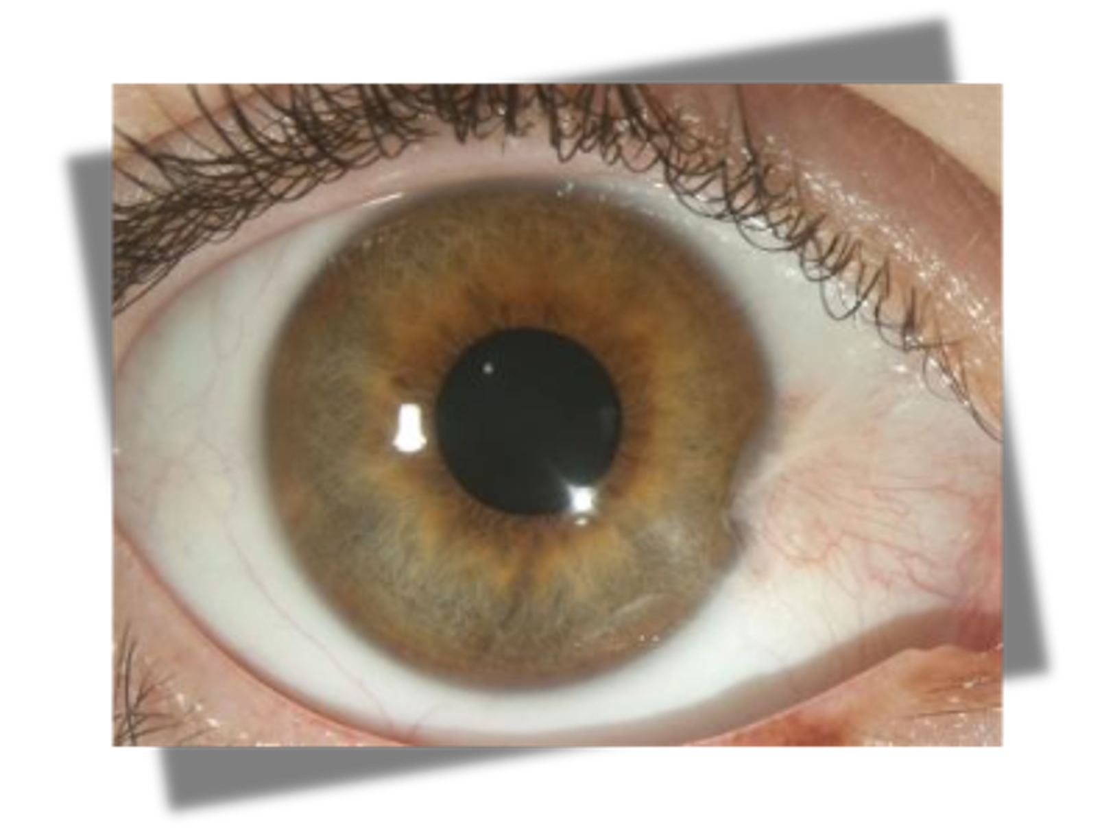 <p>triangular wedge on conjunctiva that crosses cornea</p>