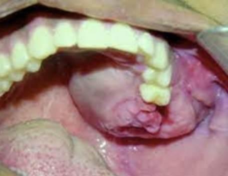 <p>Het benigne ameloblastoom is een odontogene tumor die vooral voorkomt in de molaarstreek en kaakhoekregio van de onderkaak. In het voorstadium is het vaak een toevalsbevinding. Ondanks een soms forse uitbreiding van de tumor, geeft het Ameloblastoom zelden aanleiding tot uitval van sensibiliteit van betrokken nervi. Ze zorgen vaak voor verplaatsing van de naburige elementen.</p>