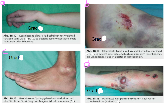 <p>Weichteilschaden</p><p></p>