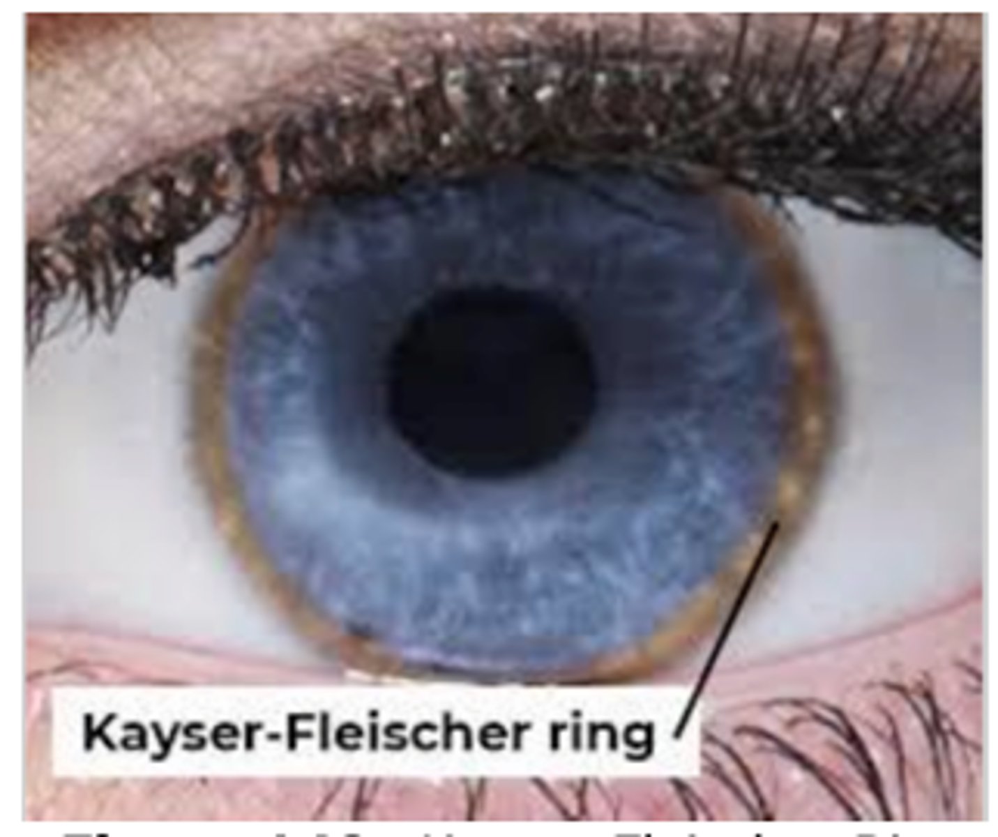 <p>Disorder of copper metabolism leading to its accumulation; onset of parkinsonism before age 40, Kayser-Fleischer rings in eye, wing-beating tremor</p>