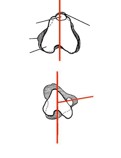 <ul><li><p>Permenant luxation</p></li><li><p>Cannot be reduced manually </p></li><li><p>Trochlear groove absent or severely eroded trochlear ridges</p></li><li><p>Severe gait abnormalities </p></li><li><p>Look for concurrent cruciate ligament tears</p></li><li><p><strong>Surgery indicated- prognosis is more guarded</strong></p></li></ul><p></p>