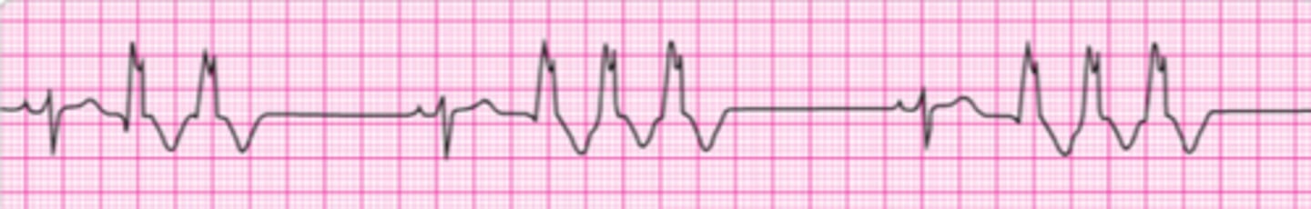 <p>A patient has been resuscitated from cardiac arrest and is being prepared for transport. She is intubated and is receiving 100% oxygen. Blood pressure is 80/60 mm Hg. During the resuscitation, she received 2 doses of epinephrine 1 mg and 1 does of amiodarone 300 mg IV. You now observe this rhythm on the cardiac monitor. The rhythm abnormality is becoming more frequent and increasing in number. You should order:</p><p>1. Amiodarone 150 mg IV bolus; start infusion.</p><p>2. A repeat dose of epinephrine 1 mg IV.</p><p>3. Lidocaine 1 to 1.5 mg IV; star infusion.</p><p>4. 1 to 2 L of normal saline.</p><p>5. Amiodarone 300 mg IV.</p>