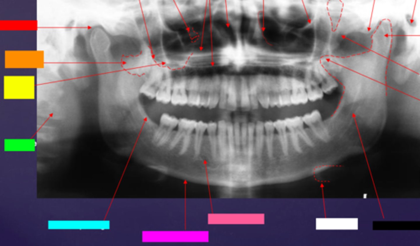 <p>ID the hard tissue anatomy indicated by the arrow pointing from the black box:</p>