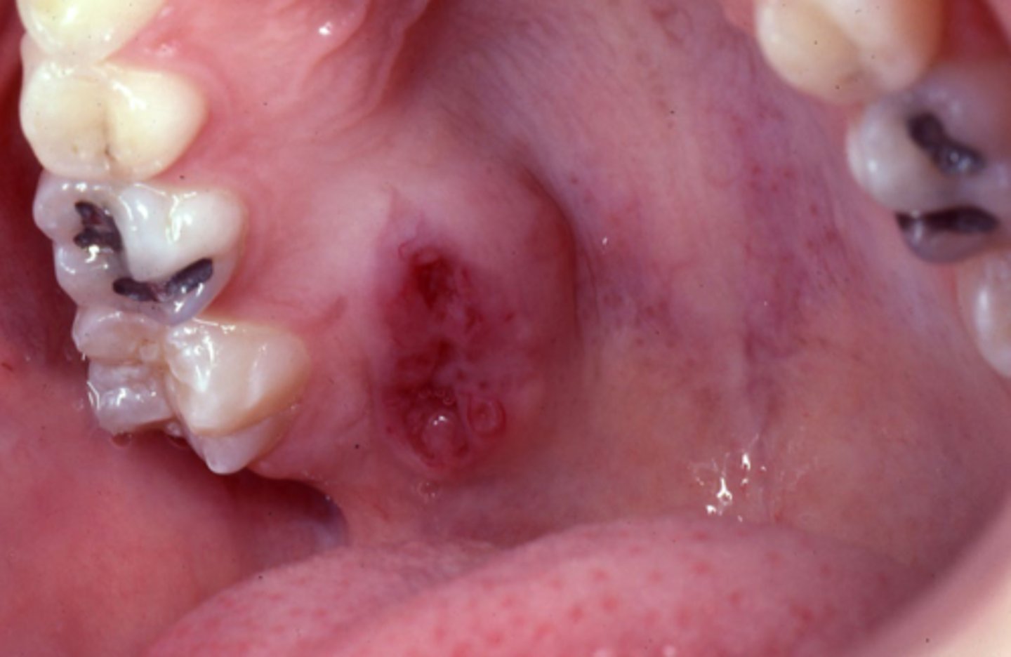 <p>- rapid growth</p><p>- variable pain</p><p>- ulcers</p><p>- increased vasculature</p>