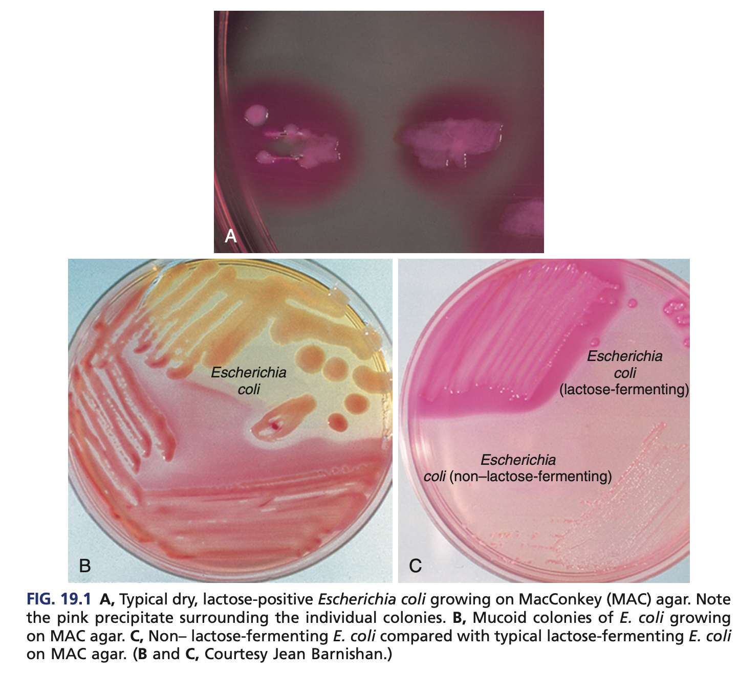 <p>neonatal meningitis </p>