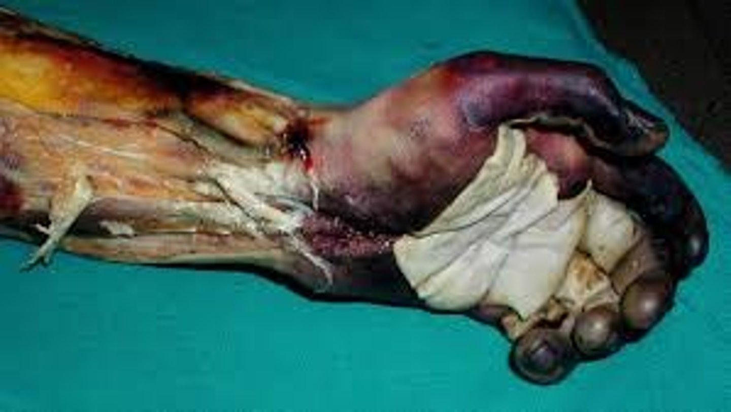 <p>full thickness, plus involvement of bone and muscle underneath</p><p>these burns are dry and dull</p><p>exposed tissue may include bones and muscles as well as ligaments and tendons</p>