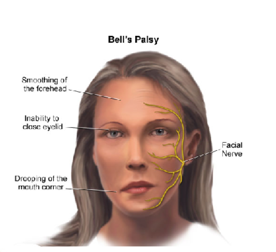 <p>Paralysis of facial muscles due to infection of facial nerves </p>