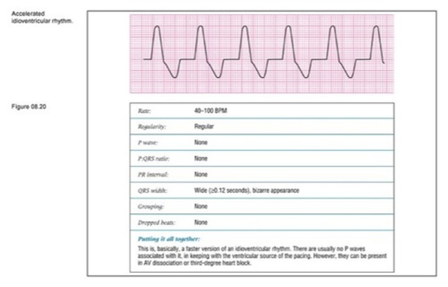 <p>Accelerated idioventricular rhythm has wide QRS complexes</p>