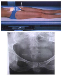 <p><span><strong>PP: </strong>Supine or prone (patient w/painful injury/destructive disease)</span></p><p><span><strong>RP</strong>: 2 in. superior to pubic symphysis (supine); Palpable coccyx (prone)</span></p><p><span><strong>CR: </strong>10o caudad (supine); 10o cephalad (prone)</span></p><p><span><strong>SS: </strong>Coccyx free of superimposition</span></p>