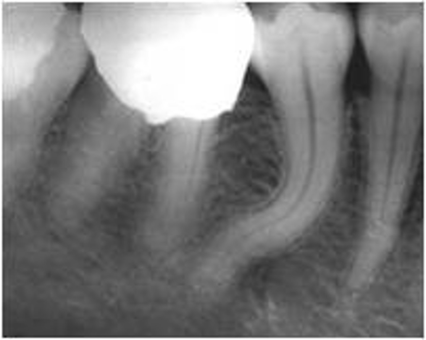 <p>-Exaggerated curve or bend in a tooth root or crown</p><p>-Difficult to extract or root canal</p>