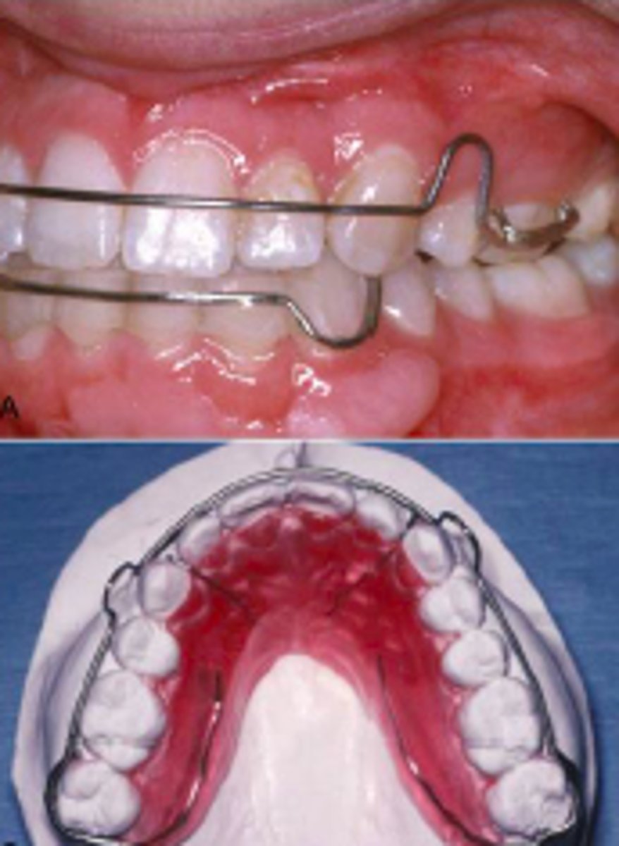 <p>outerbow controls incisors</p><p>interproximal wires - crack open space</p>