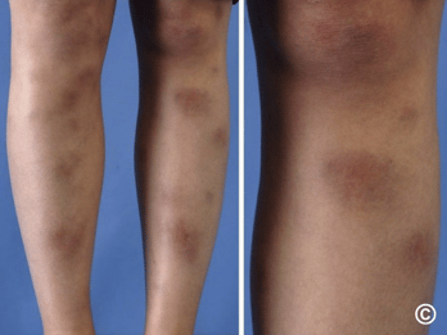 <p>name the skin pathology</p>